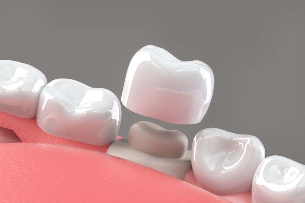 Porcelain Repair Kit - Dental-Medical - Webshop