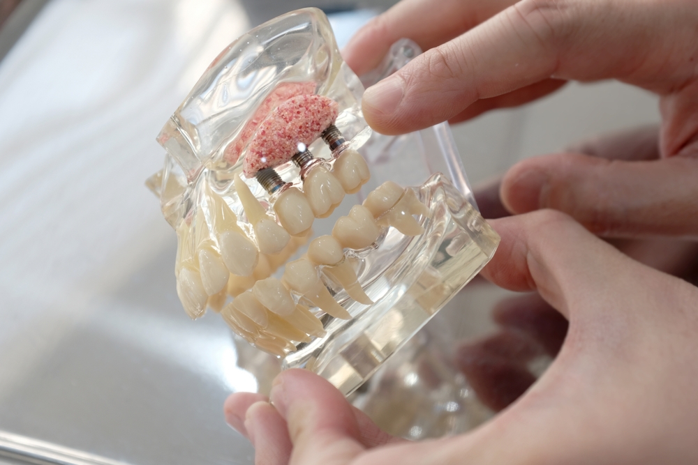 What Is the Dental Implant Process and How It Can Restore Your Smile