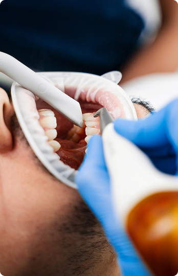 Dental procedure close-up showing a dentist in blue gloves using tools to examine a patient's teeth. The patient wears protective goggles.