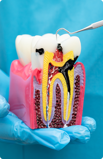 A dental model of a decayed tooth is held by a gloved hand. The model shows tooth layers and cavities, illustrating dental decay. A dental pick points at the cavity.